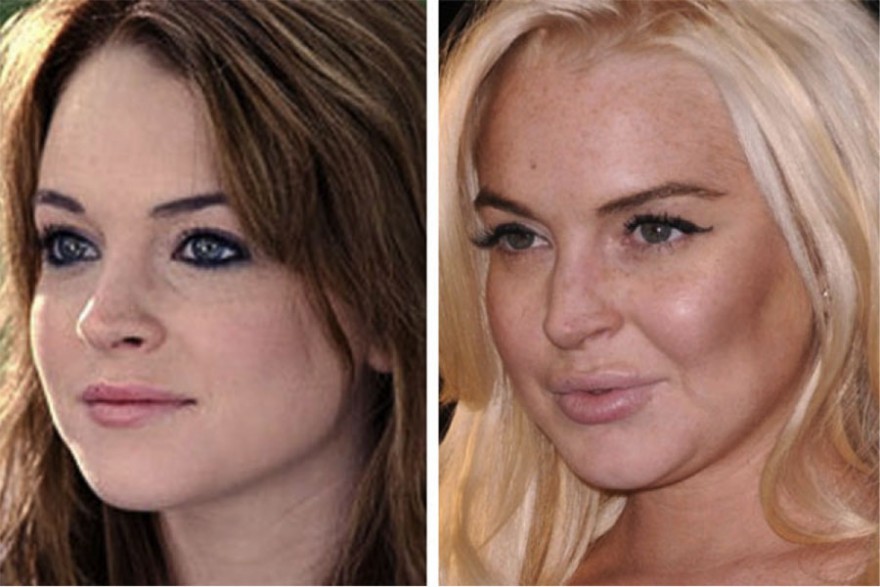 Le Top 15 des naufragés du Botox
